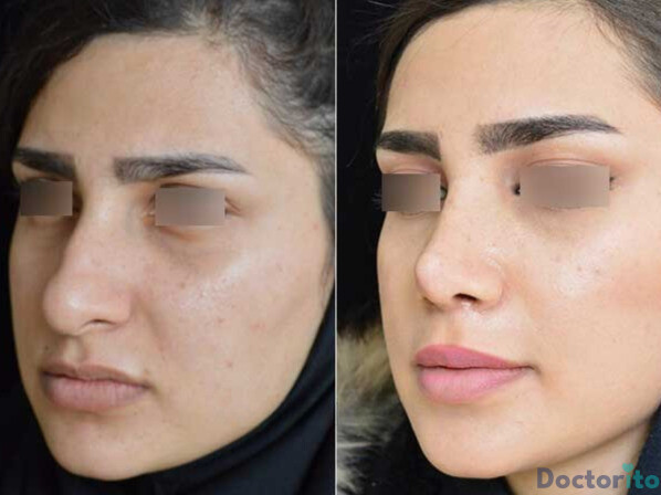 عمل بینی نیمه فانتزی 1 عکس بینی نیمه فانتزی