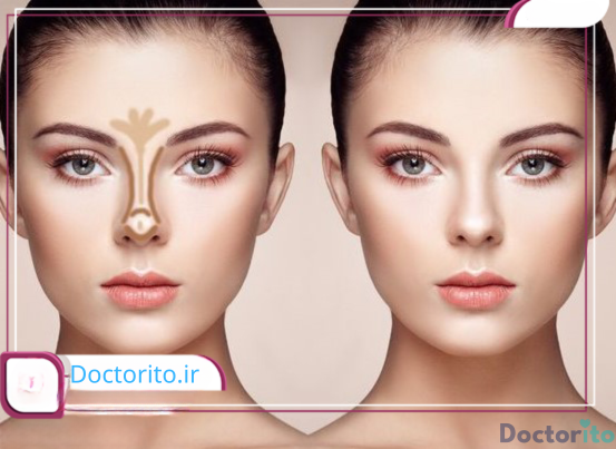 هزینه جراحی بینی در مشهد