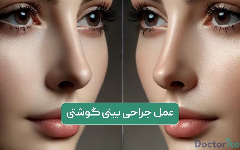 بهترین جراح بینی گوشتی در اهواز