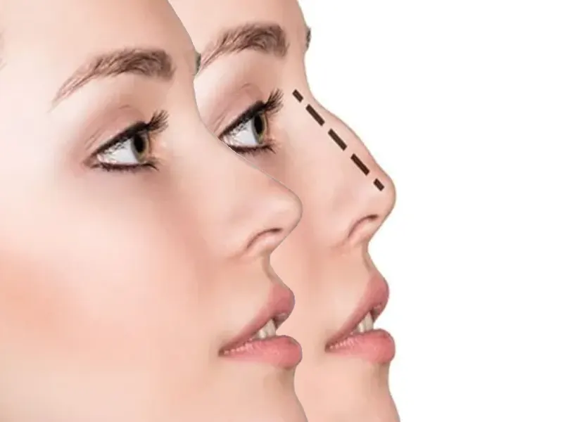 بهترین جراح بینی استخوانی در یزد