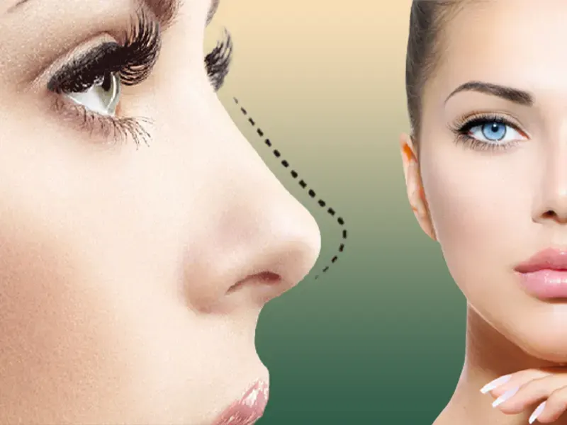 بهترین جراح بینی استخوانی در یزد