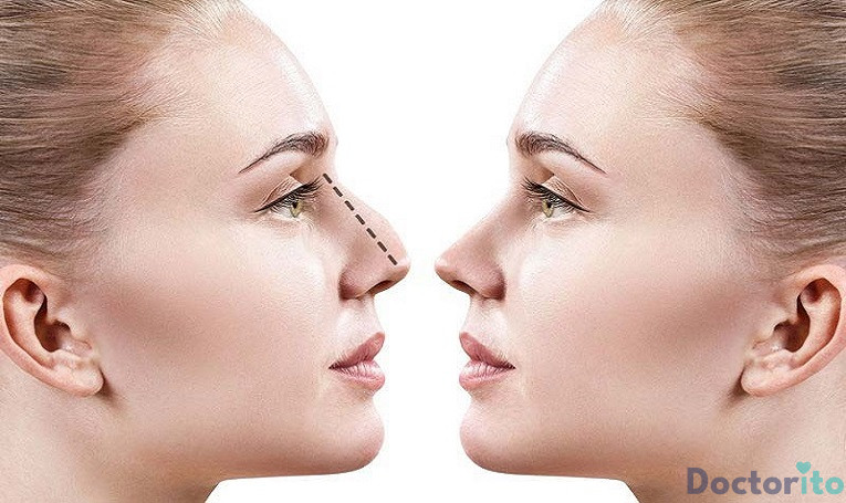 بهترین جراح بینی گوشتی در یزد