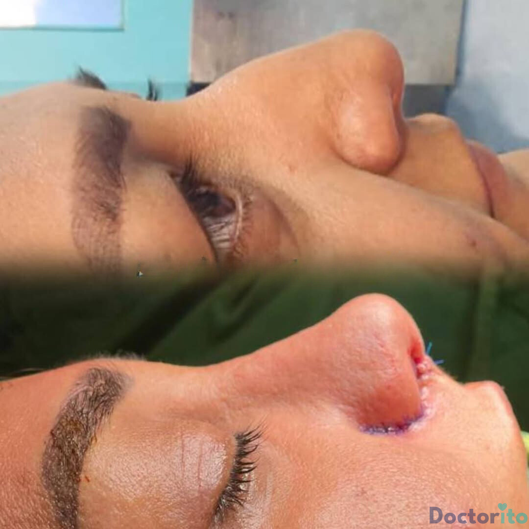 نمونه کار جراحی بینی دکتر بهروز گندمی (6)