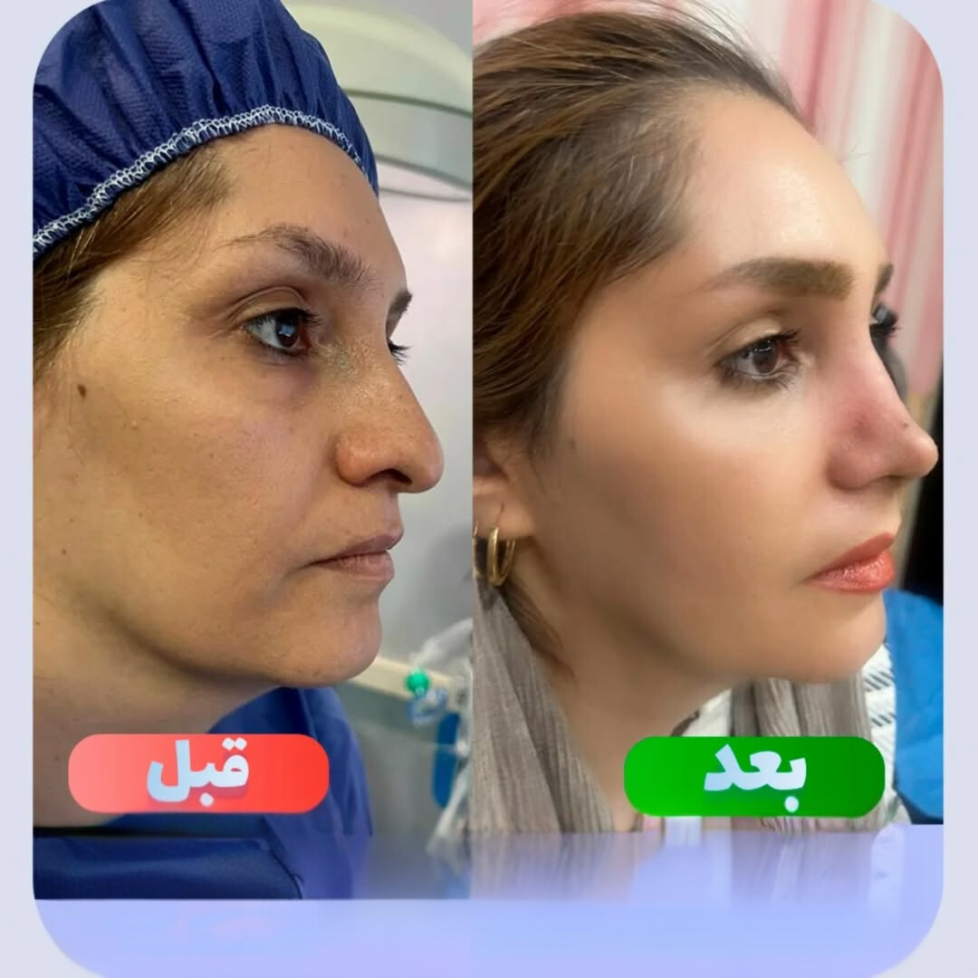 نمونه عمل بینی دکتر وحید عین آبادی 2