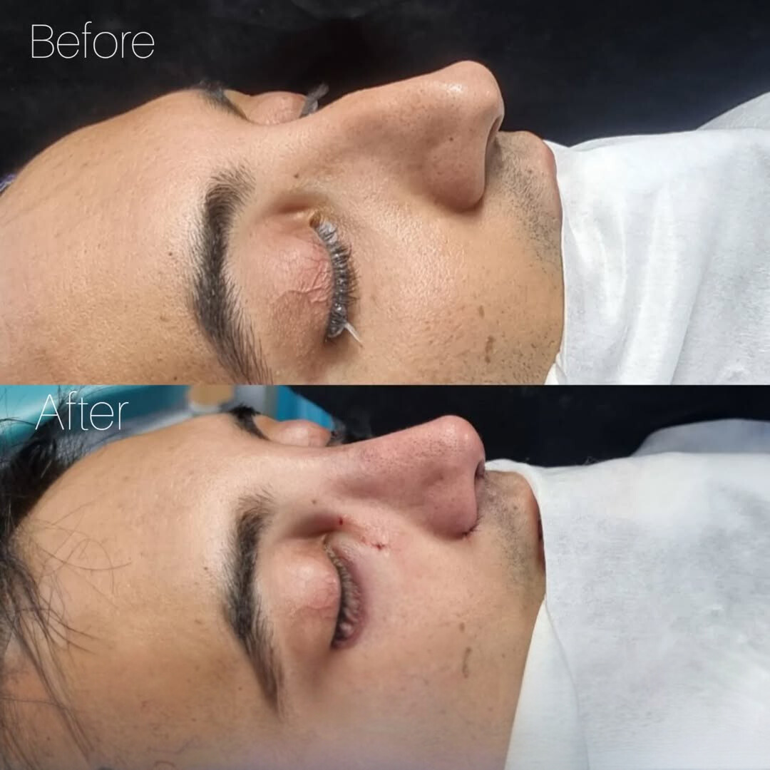 نمونه عمل بینی دکتر لیلا شریفی