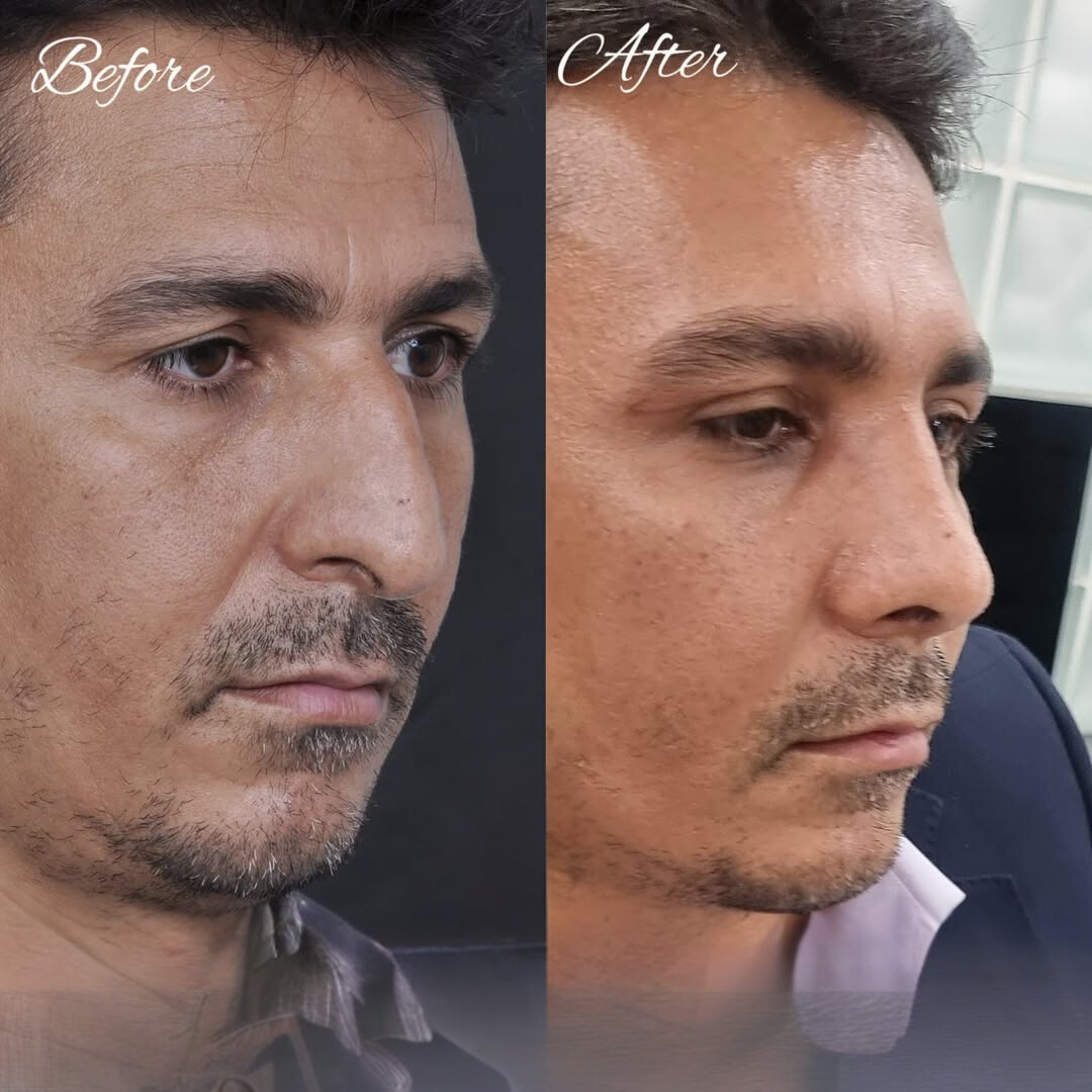 نمونه عمل بینی دکتر لیلا شریفی