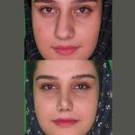 نمونه عمل بینی دکتر محسن فانی