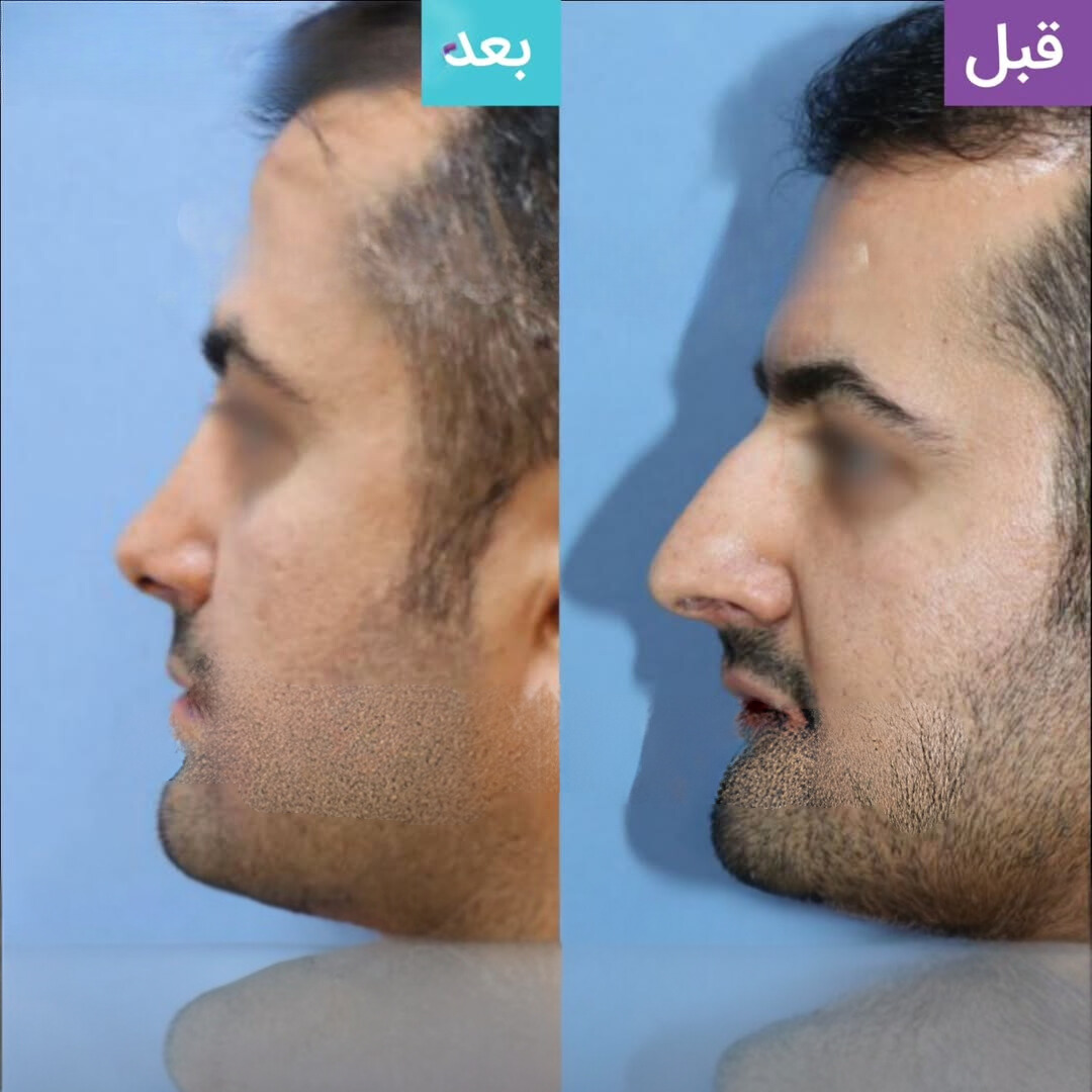 نمونه عمل بینی دکتر داریوش ساریخانی
