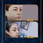 (4)نمونه عمل بینی دکتر سید علی موسوی