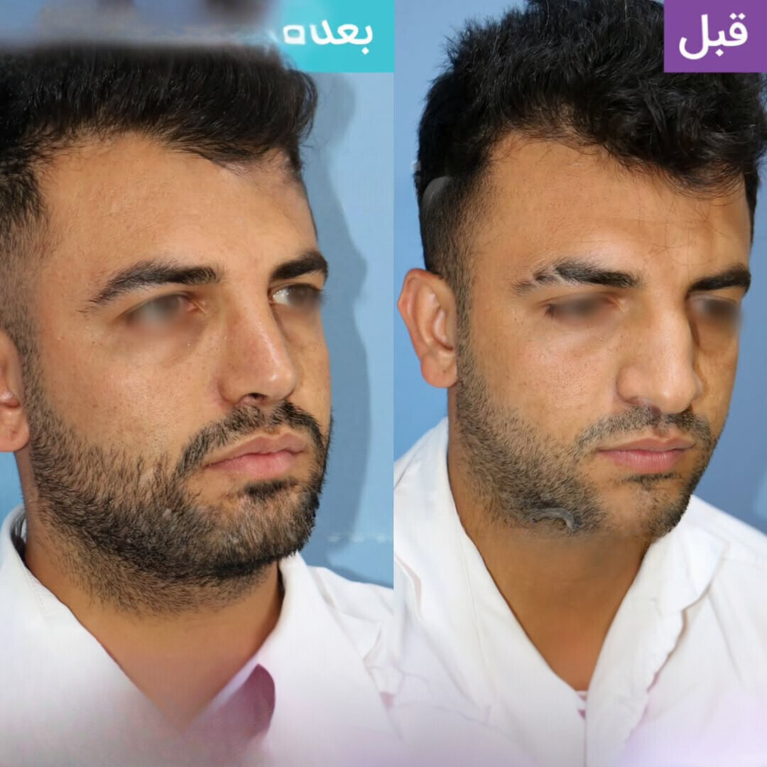نمونه عمل بینی دکتر داریوش ساریخانی