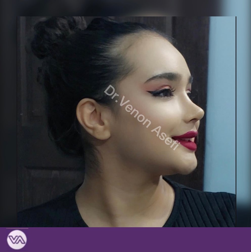 نمونه عمل بینی دکتر ونون آصفی 1
