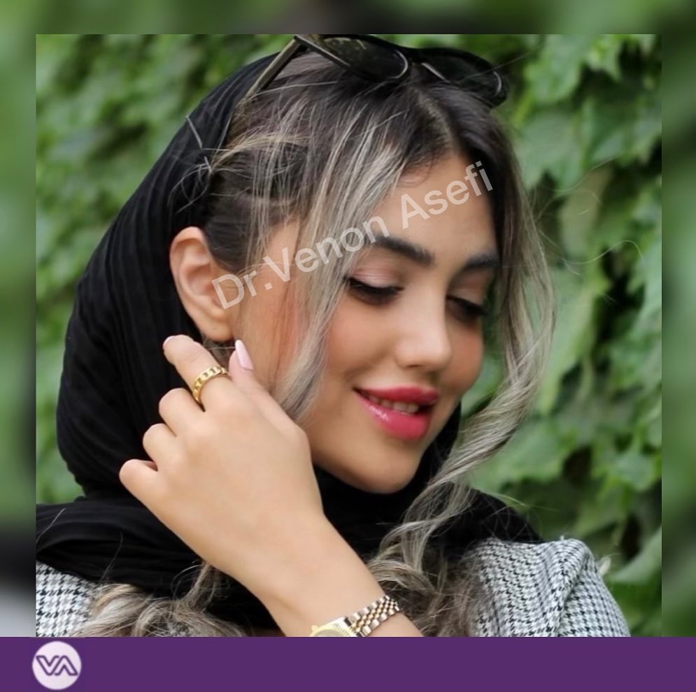 نمونه عمل بینی دکتر ونون آصفی 2