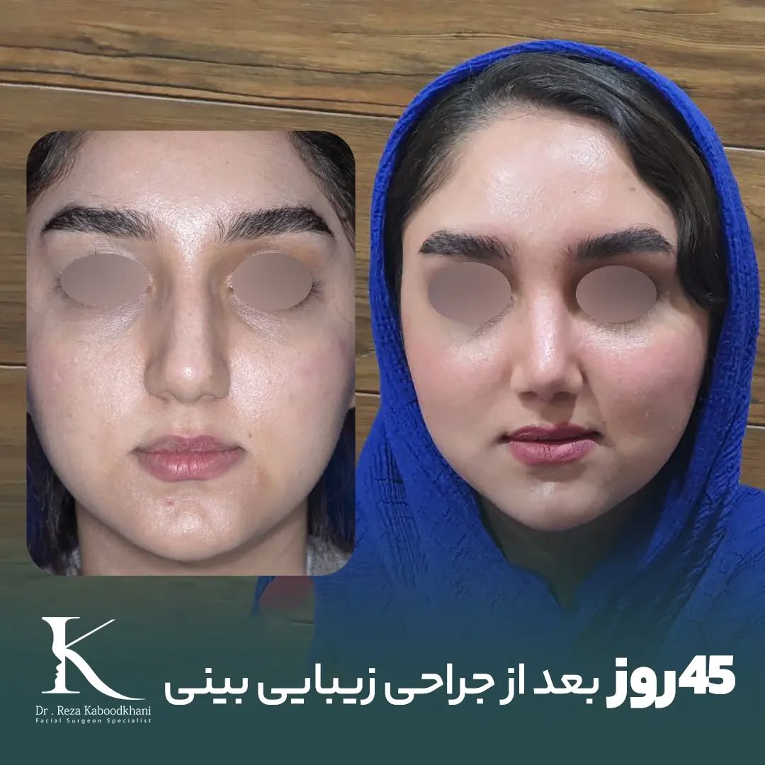 نمونه عمل بینی دکتر رضا کبودخانی