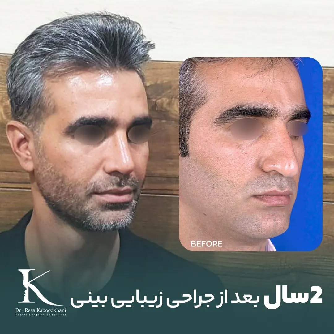 نمونه عمل بینی دکتر رضا کبودخانی
