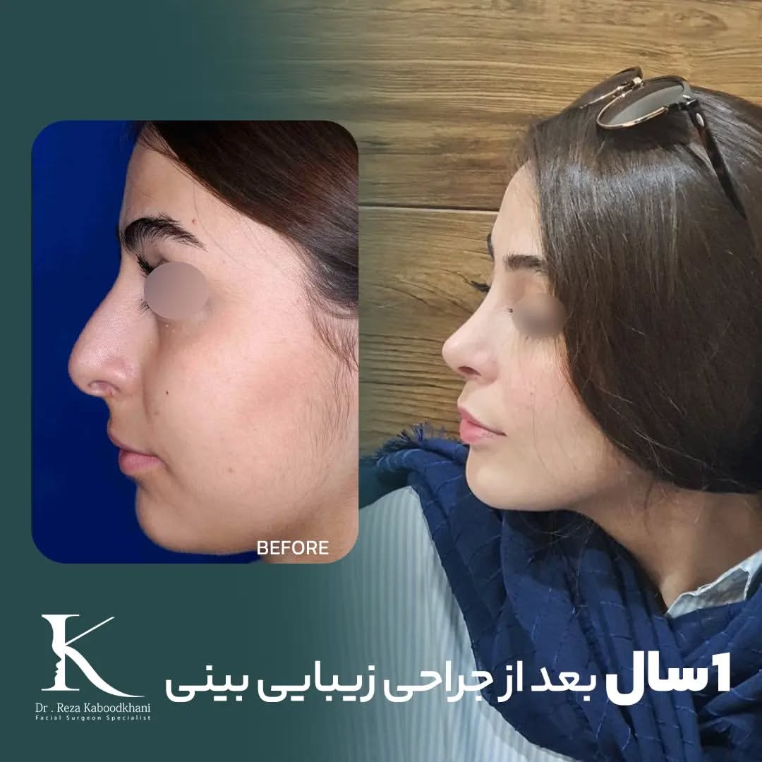 نمونه عمل بینی دکتر رضا کبودخانی