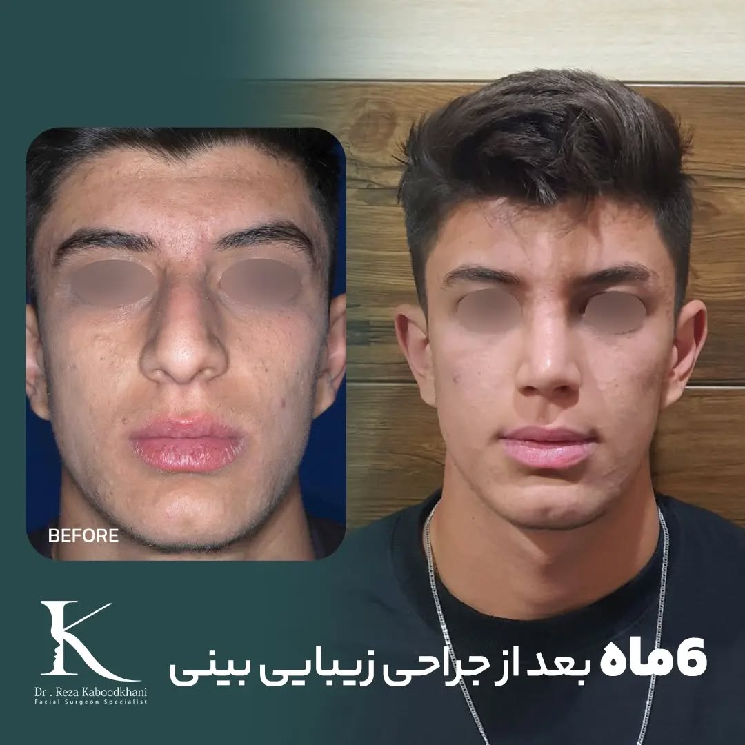 نمونه عمل بینی دکتر رضا کبودخانی