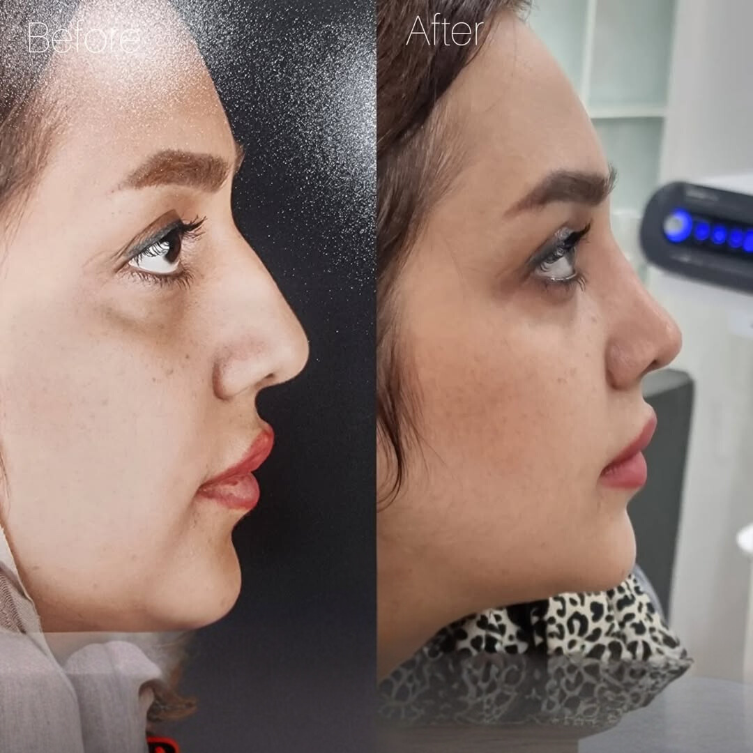 نمونه عمل بینی دکتر لیلا شریفی