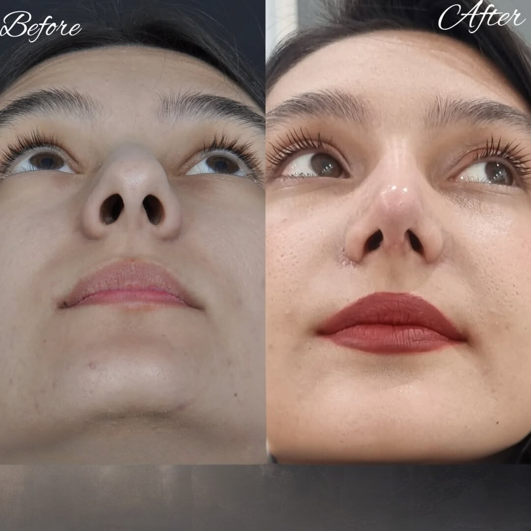 نمونه عمل بینی دکتر لیلا شریفی