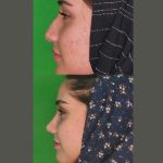 نمونه عمل بینی دکتر محسن فانی