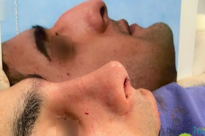 نمونه عمل بینی دکتر شهاب خسروی (3)
