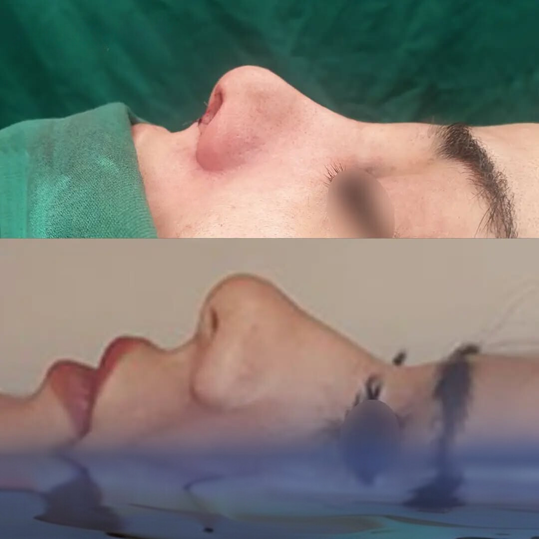 نمونه جراحی بینی دکتر حامد هاتفی 4