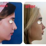 نمونه عمل بینی دکتر احمد کرباسی (1)