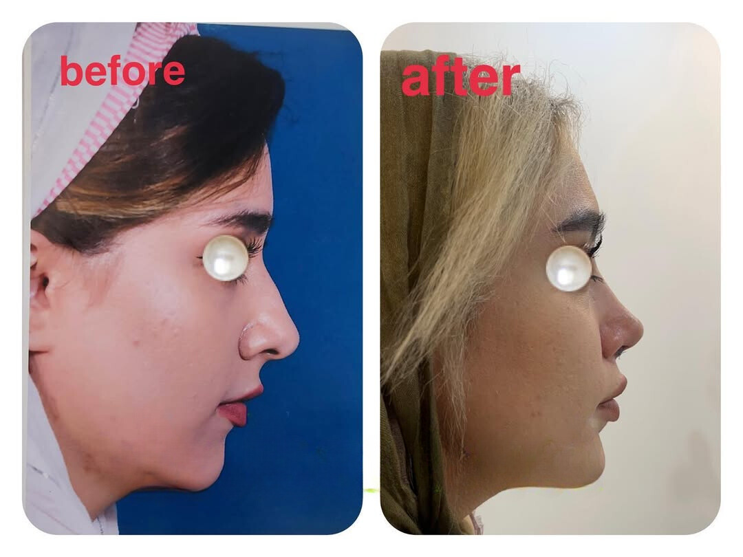 نمونه عمل بینی دکتر احمد کرباسی (1)
