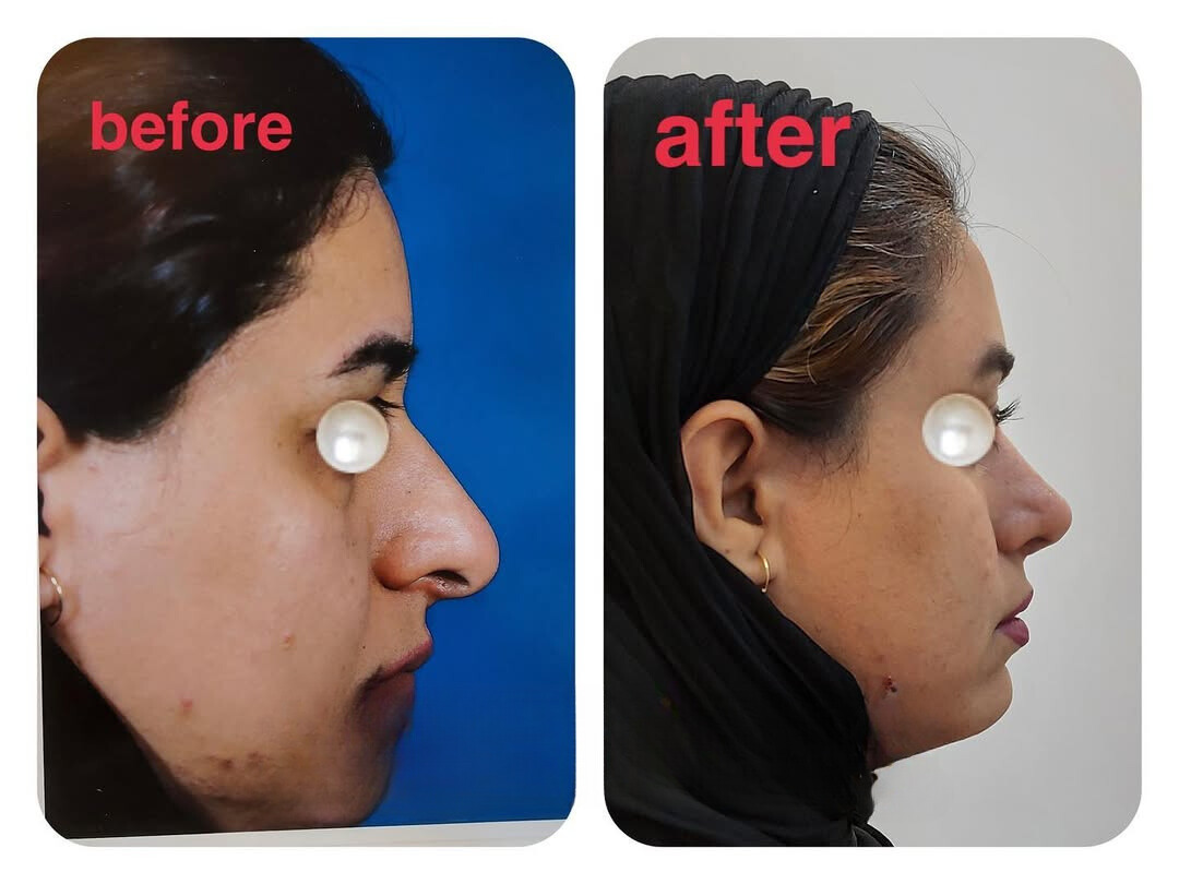 نمونه عمل بینی دکتر احمد کرباسی (2)