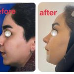 نمونه عمل بینی دکتر احمد کرباسی (4)