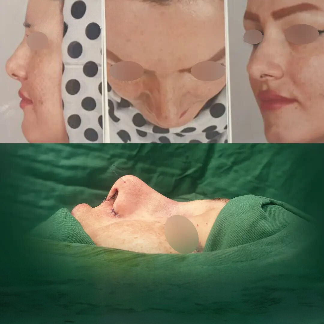نمونه عمل بینی دکتر حامد هاتفی 2