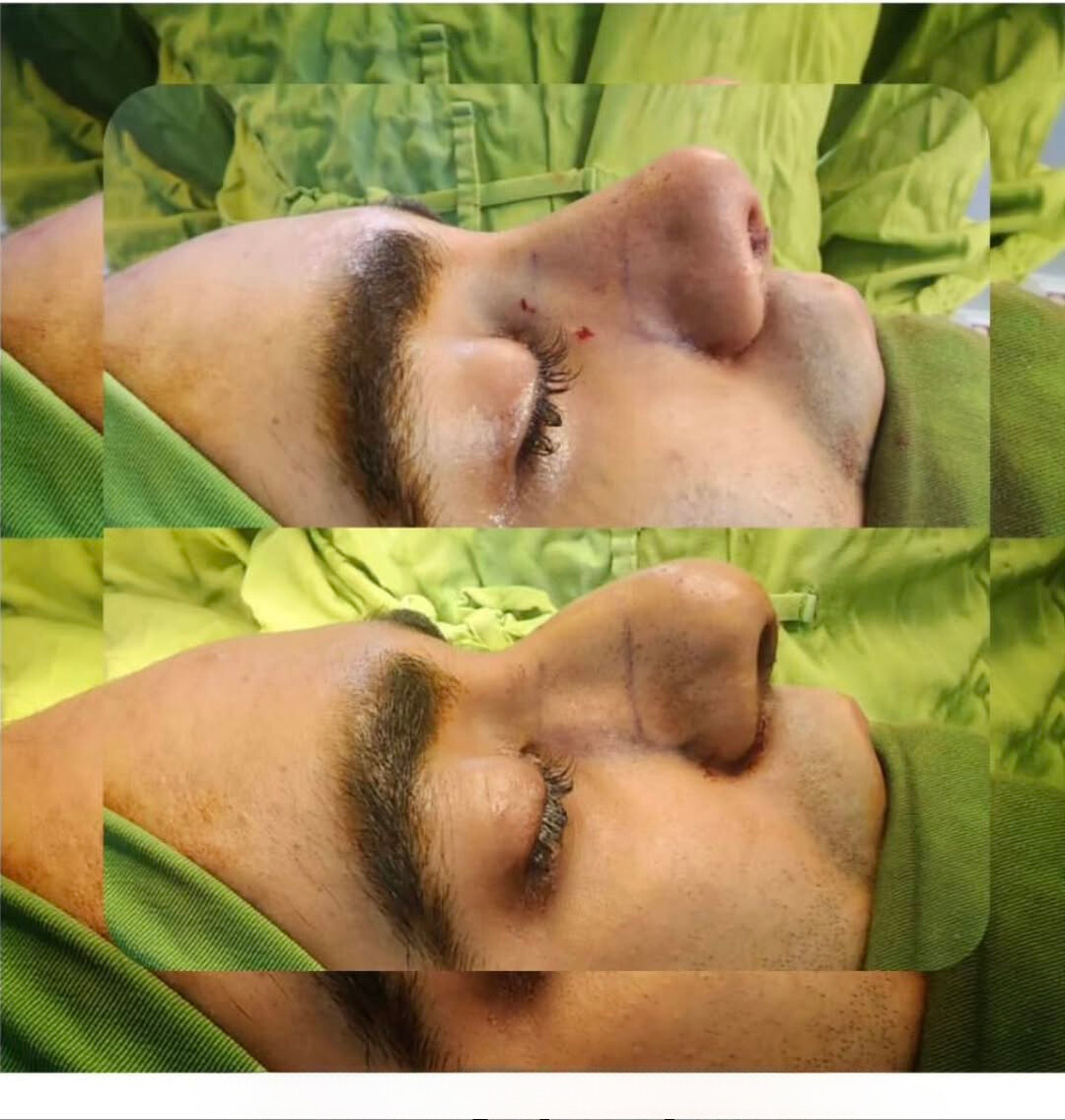 نمونه عمل بینی دکتر سعید مرزبان 3