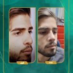 نمونه عمل بینی دکتر سید علی موسوی (3)