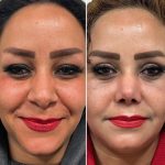 نمونه عمل بینی دکتر مجتبی میبدیان 3