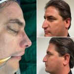 نمونه عمل بینی دکتر مجتبی میبدیان 4