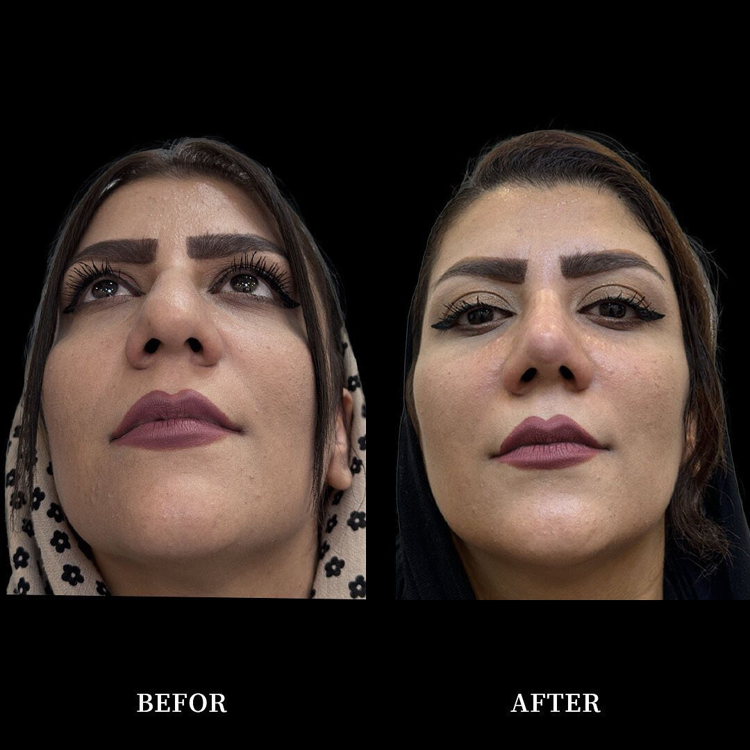 نمونه عمل بینی دکتر محمدحسین دادگرنیا