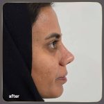 نمونه عمل بینی دکتر محمدعلی آقایی (2)