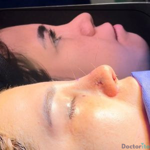 نمونه عمل بینی دکتر امیرعلی میرفخرایی 3