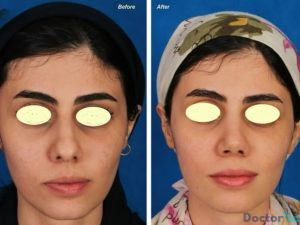 نمونه عمل بینی دکتر صمد غیاثی 6