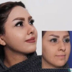 نمونه عمل بینی دکتر امیر نیازی 4
