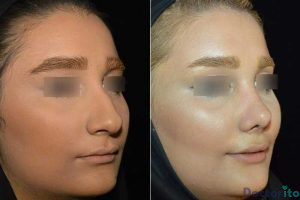 نمونه عمل بینی دکتر کاظمی3
