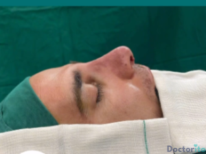نمونه عمل بینی دکتر صمد غیاثی 3