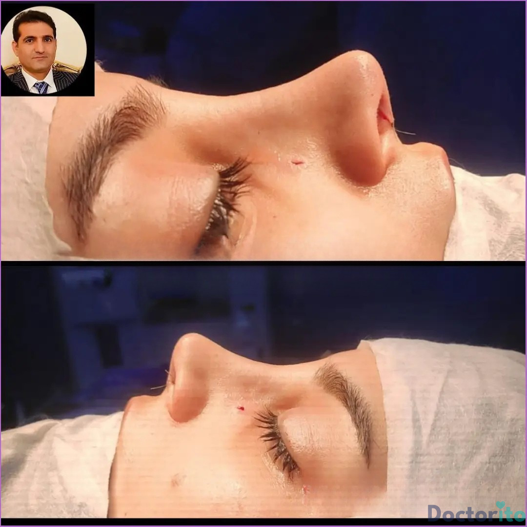 نمونه عمل بینی دکتر امید قاسم زاده 3