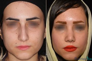 نمونه عمل بینی دکتر کاظمی4