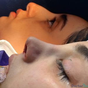 نمونه عمل بینی دکتر امیرعلی میرفخرایی 2