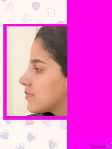 نمونه عمل بینی دکتر سحر زاهدی3