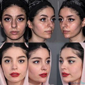 نمونه عمل بینی دکتر حسام جهاندیده 5