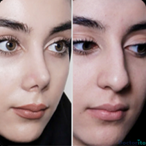 نمونه عمل بینی دکتر امیر نیازی 1