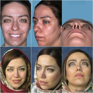 نمونه عمل بینی دکتر حسام جهاندیده 3