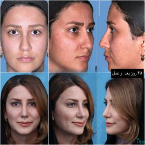نمونه عمل بینی دکتر حسام جهاندیده 1