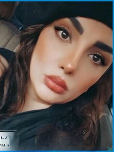 نمونه عمل بینی دکتر شبنم حاج علیپور (6)